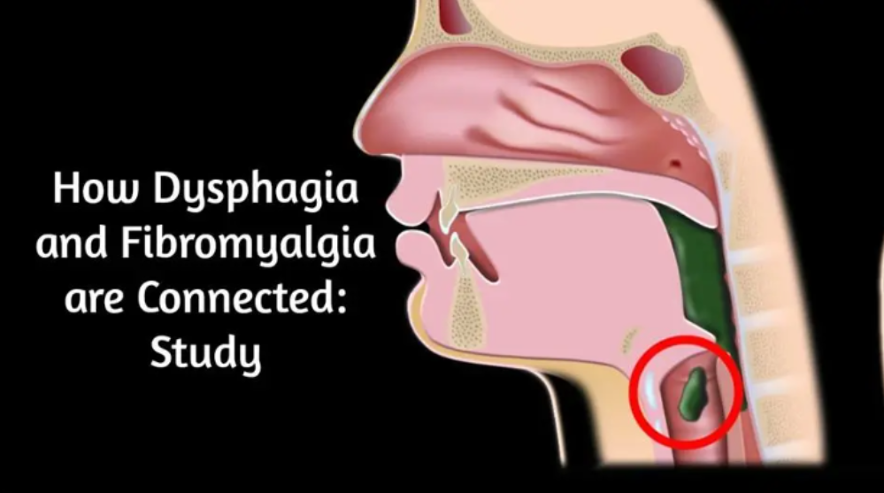 How Dysphagia and Fibromyalgia are Connected